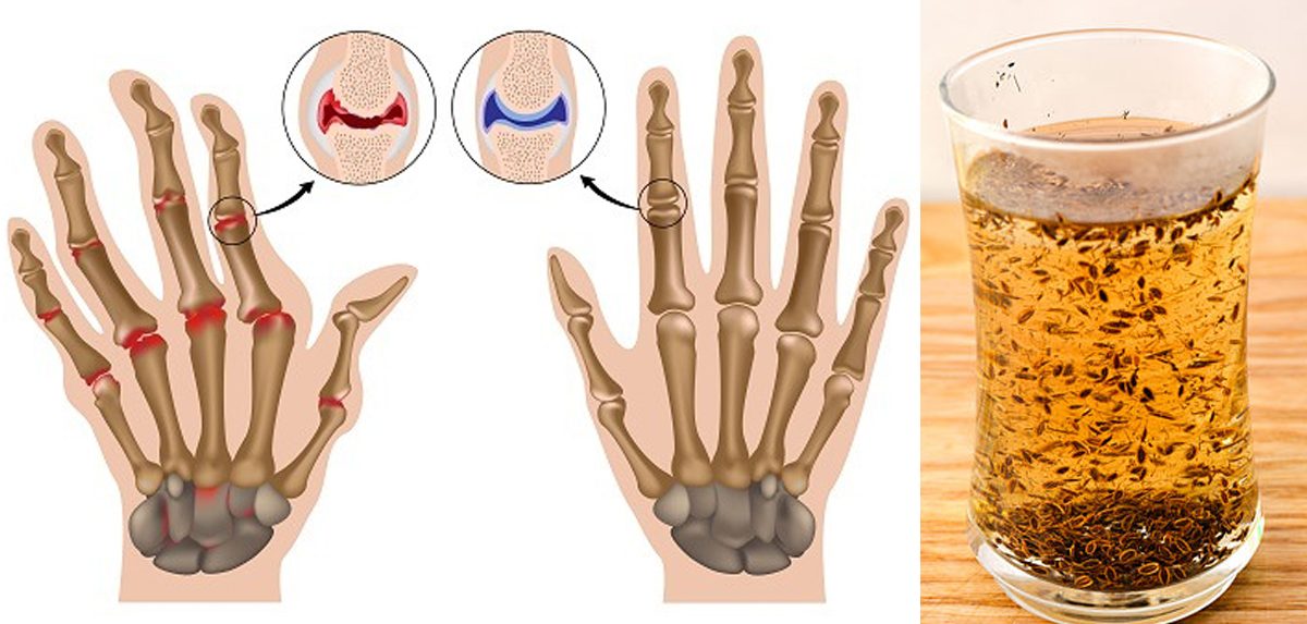 remedii de casă pentru artrită tratamentul articulației gleznei